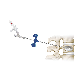detail image1 Kyphoplasty Balloon system